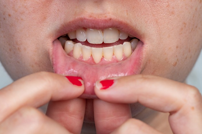 Diş Eti Çekilmesi Nasıl Tedavi Edilir