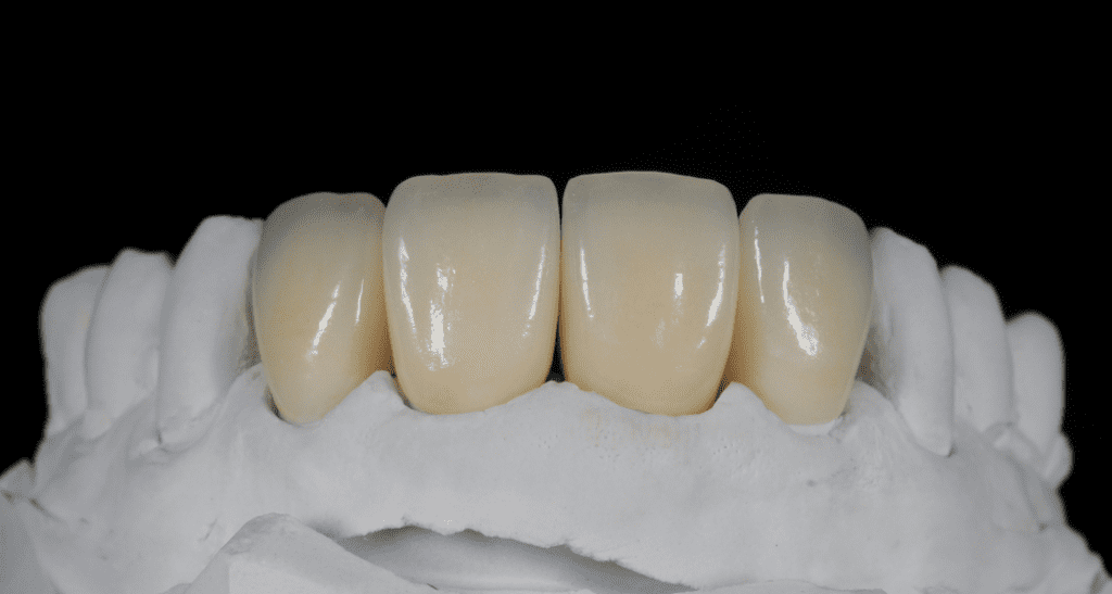 Zirkonyum Diş Kaplamanın Avantajları Nelerdir?